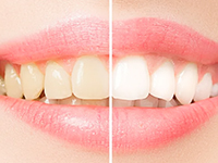 痛みを感じることがほとんどなく、しっかりと効果を実感できるホワイトニングです。